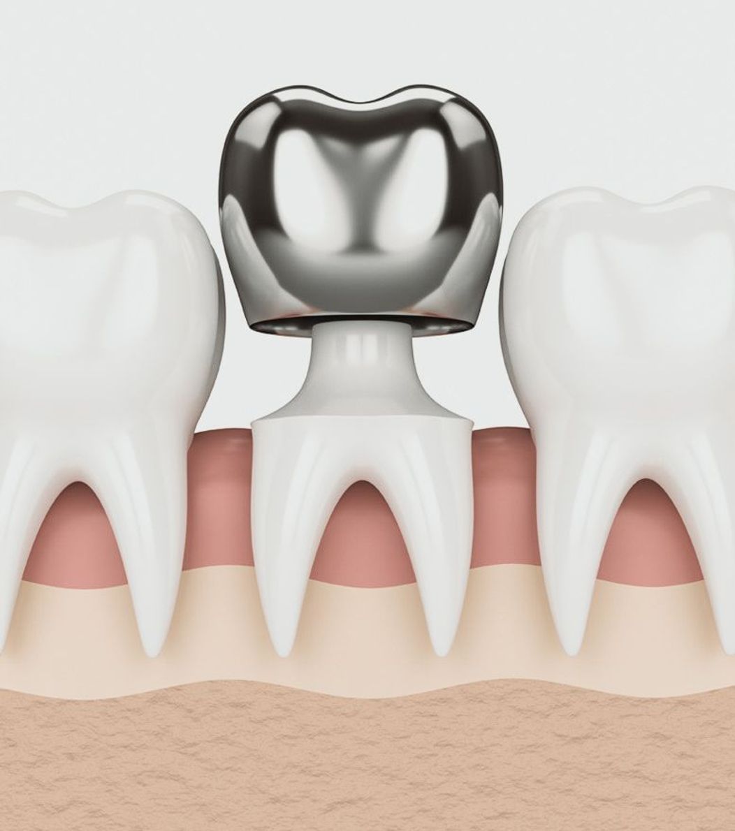 An image of a metal crown being placed on a tooth