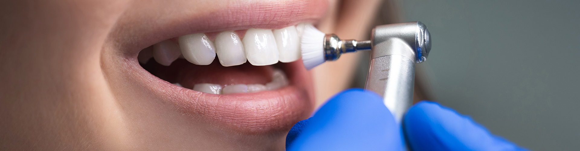Close-up of purple-gloved hands polishing teeth during a dental cleaning.