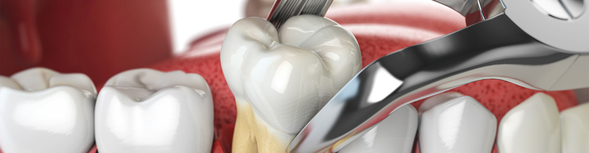 Dental pliers pulling a tooth from a model mandible.