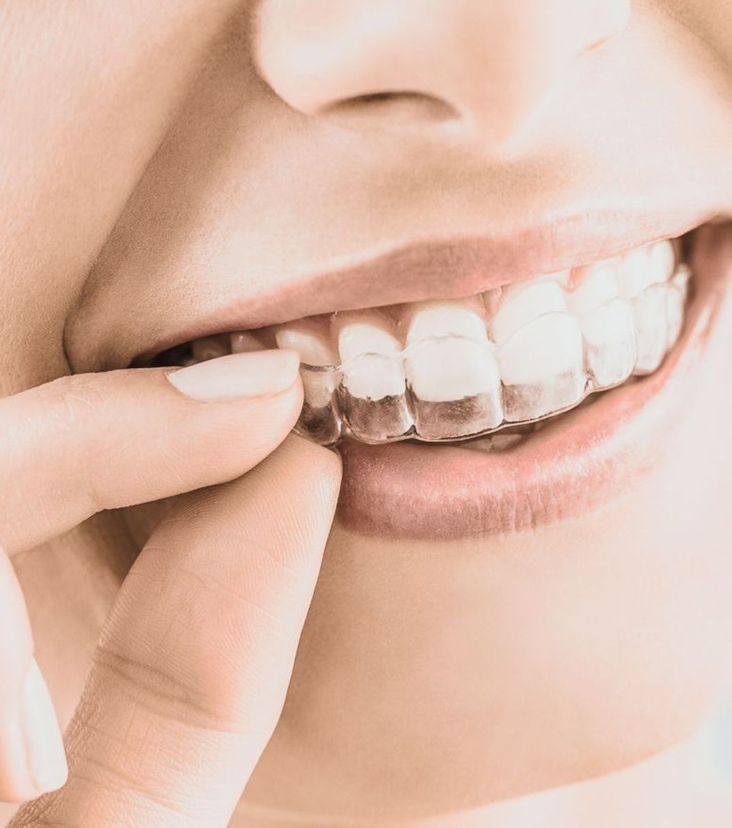 An image of the Invisalign aligners on the teeth