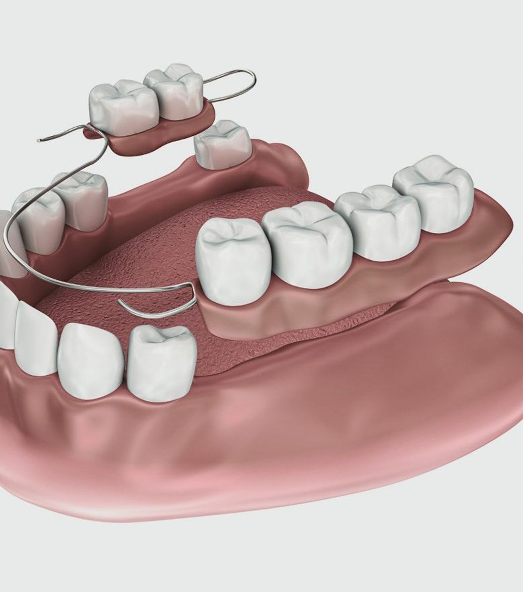 An image of partial dentures being placed