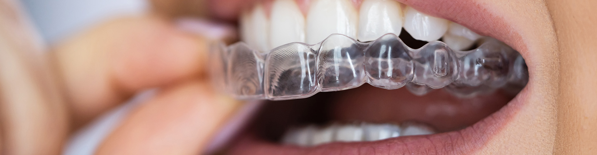 Woman placing clear aligner on upper teeth.