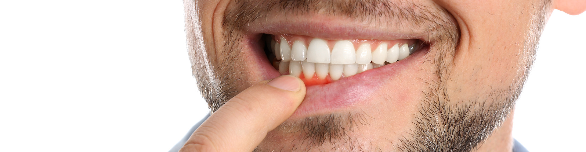 man holding down lip to reveal inflamed gums