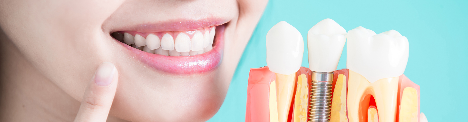 A woman smiling while holding a tooth model that shows a dental implant.
