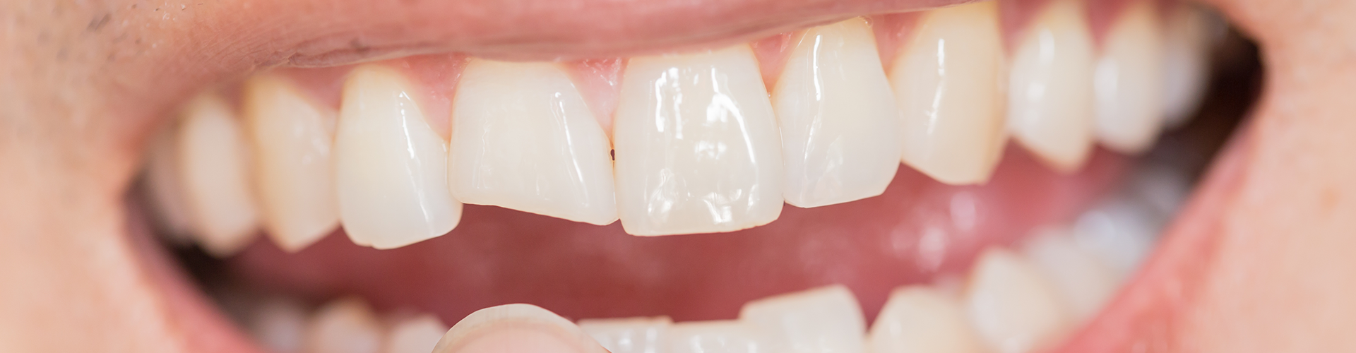 Close up of a finger pointing to a broken tooth.