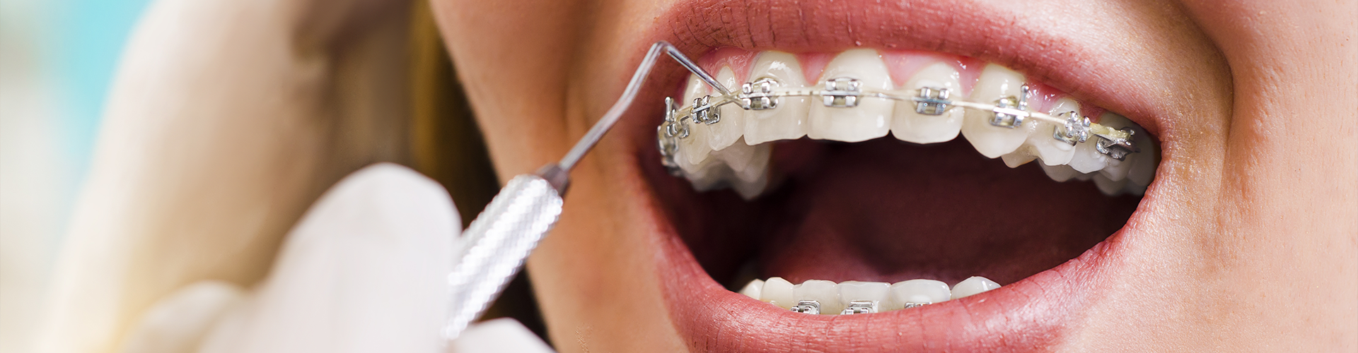 Gloved hand using dental tool on person's braces.