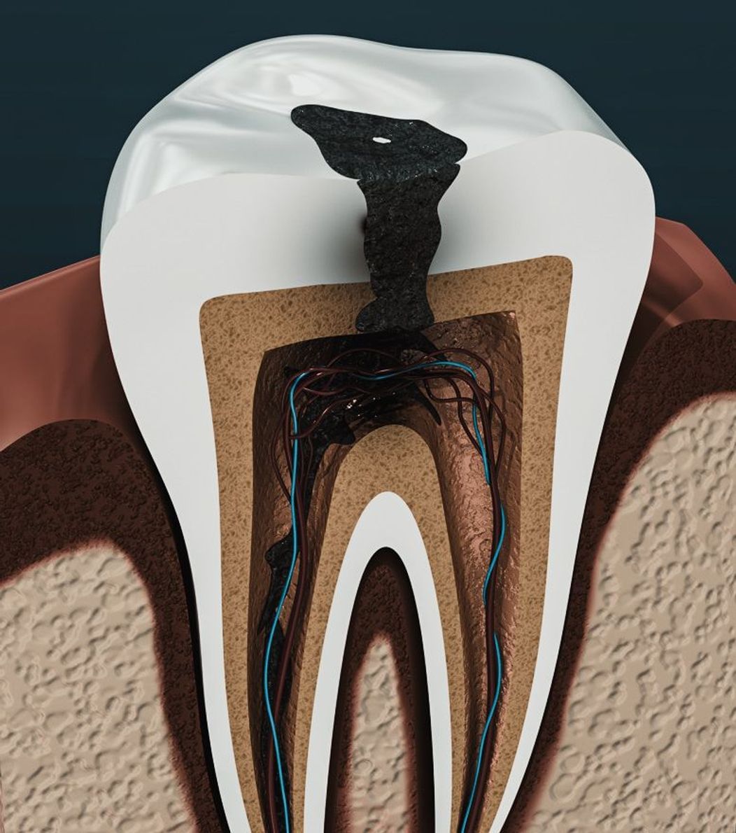 An image of the anatomy of a tooth showing an abscess on the tooth