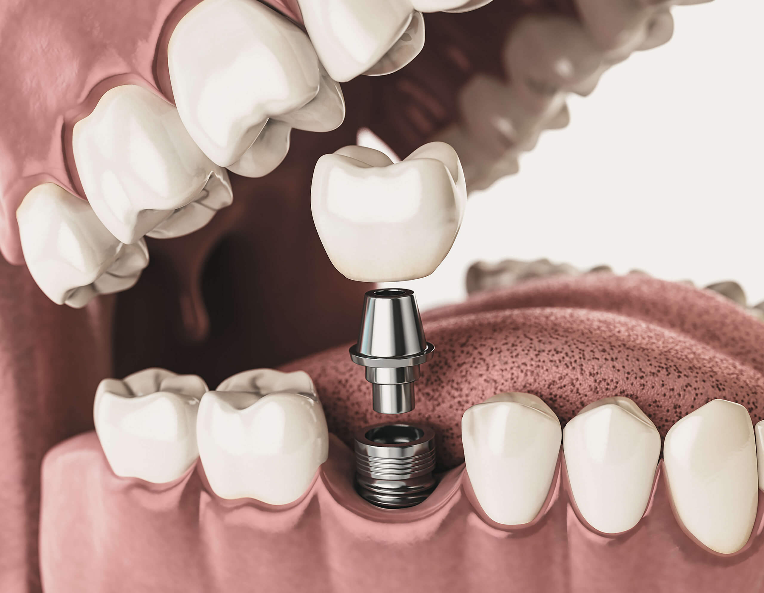 Image of a dental implant being placed