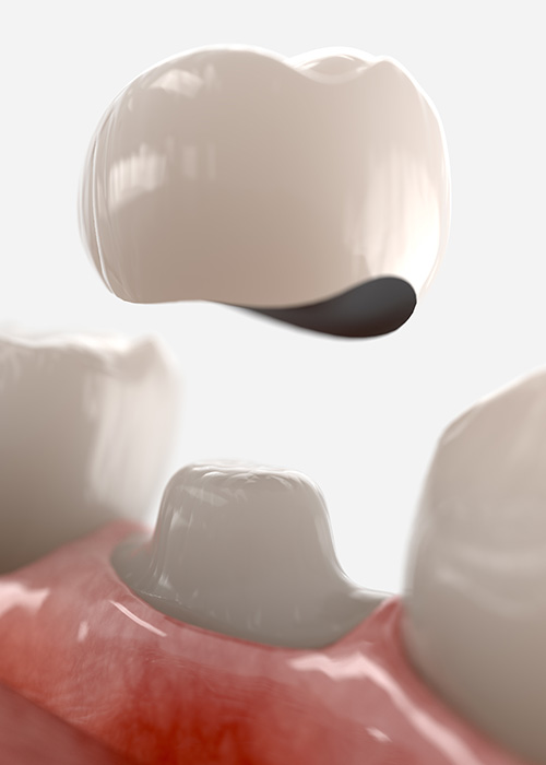 3d render dental crown.