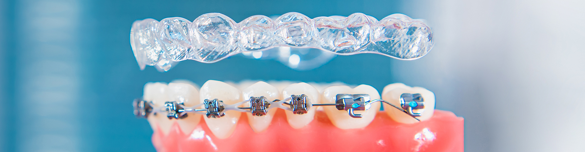 Hand holding braces model with clear aligner above it.